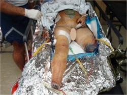 Pediatric Blast Injury: Bilateral Amputation – Part 2 – Disaster-RX